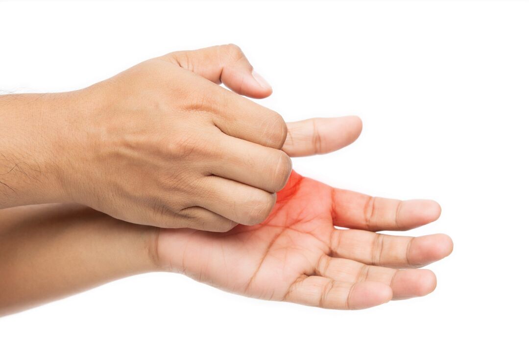 Srbenje z glivico in njegovo zdravljenje s kremo Demyxil